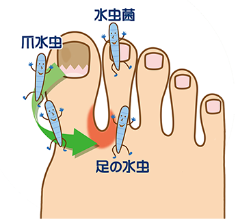 爪水虫 爪白癬 10人に1人が感染していると言われている水虫 その中で爪に発症する爪白癬の完治を目指して 岐阜市 整形外科 医療法人ごとう整形外科